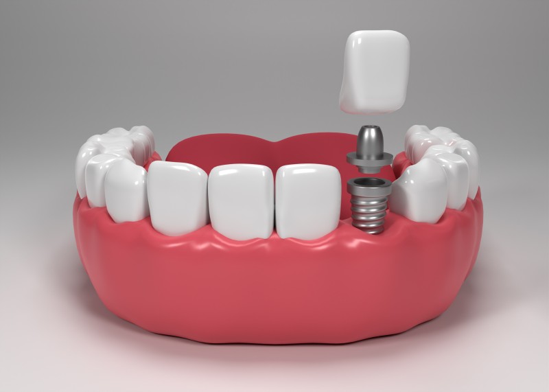 dental-implants